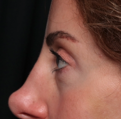 Blepharoplasty and Brow Lift Before & After Patient #34363